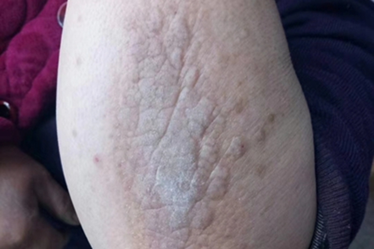 局限性神经性皮炎胳膊脱皮图