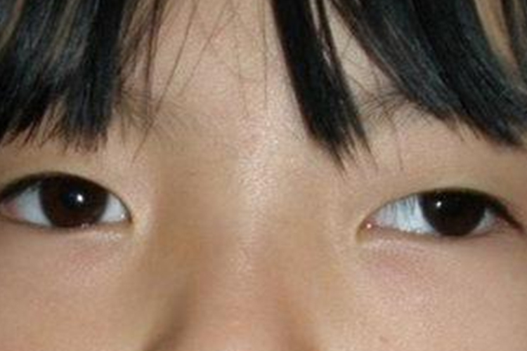 小孩子有点外斜视图 小孩子有点外斜视图