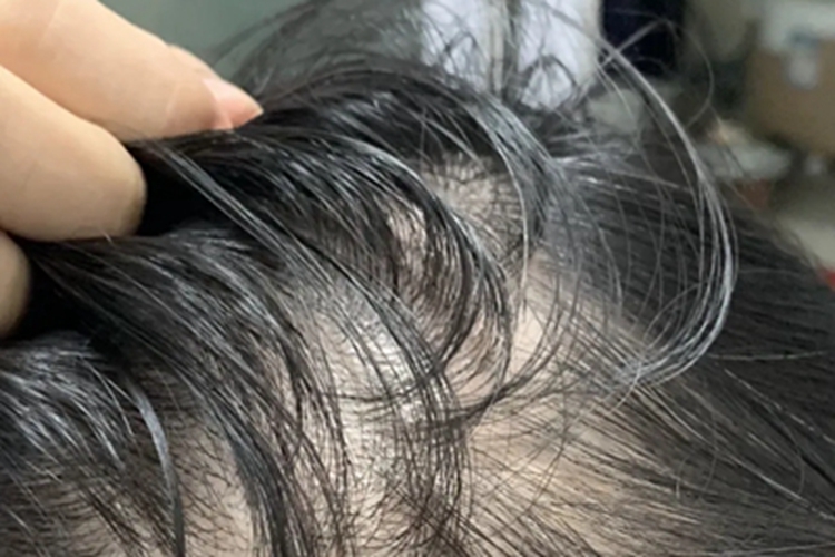 生长期脱发头发稀疏图