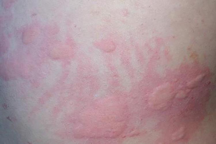 日光性荨麻疹红色风团图