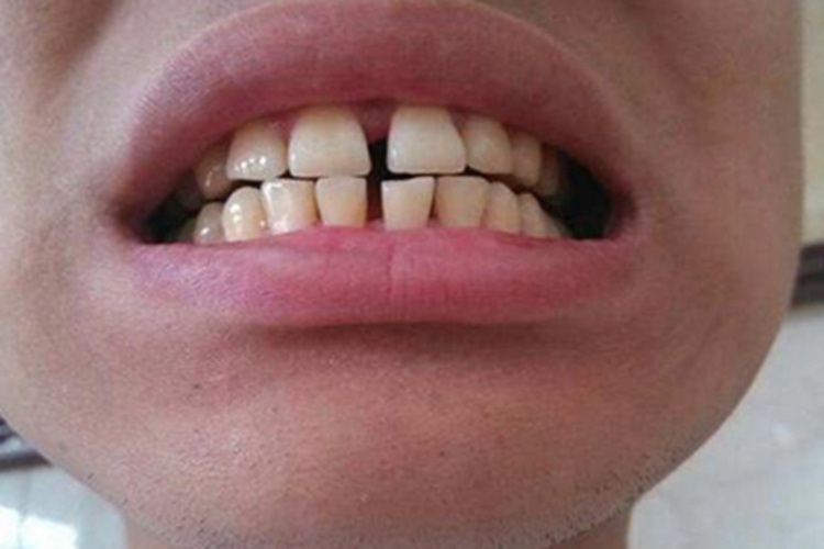 巨颌症牙齿畸形牙缝大图 巨颌症牙齿畸形牙缝大图