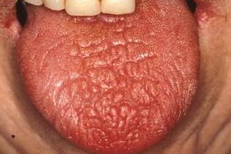 舌红干燥萎缩图