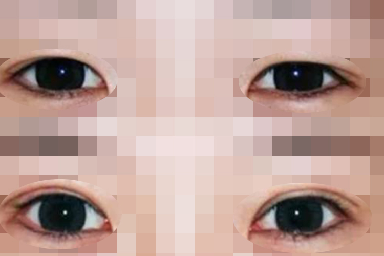 内眦赘皮矫正术前后对比图