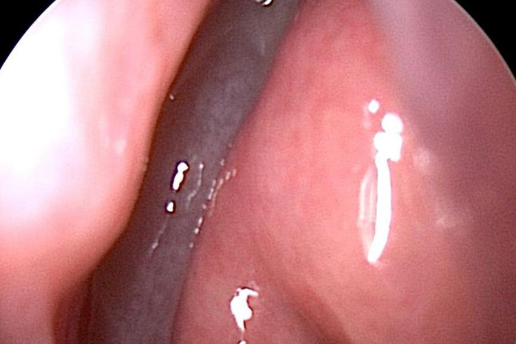 慢性鼻窦炎鼻息肉图
