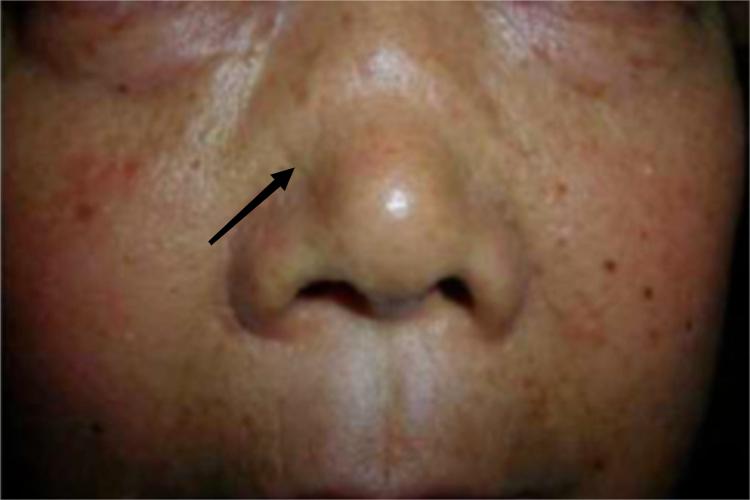 萎缩性多软骨炎畸形图