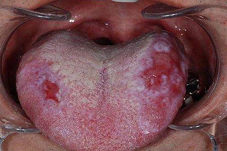 舌扁平苔藓舌头症状图 舌扁平苔藓舌头症状图