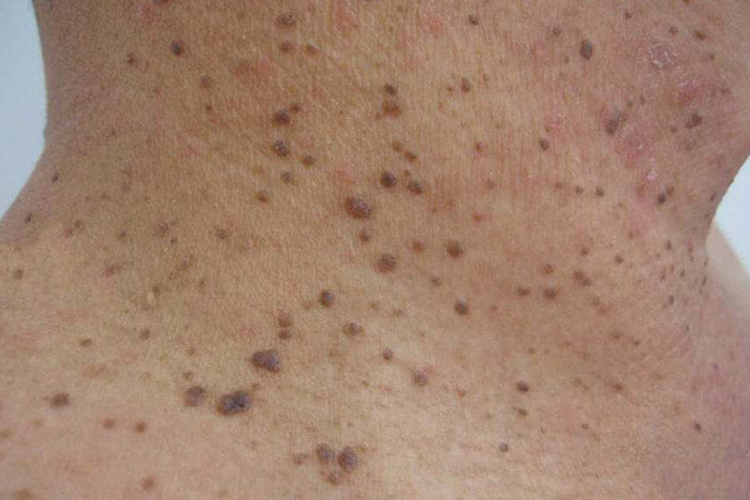 脖子脂溢性角化病图 脖子脂溢性角化病图