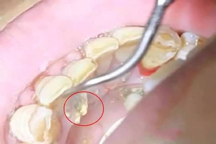 牙结石脱落图 牙结石脱落图