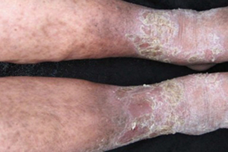 淤积性皮炎脚踝症状图 淤积性皮炎脚踝症状图