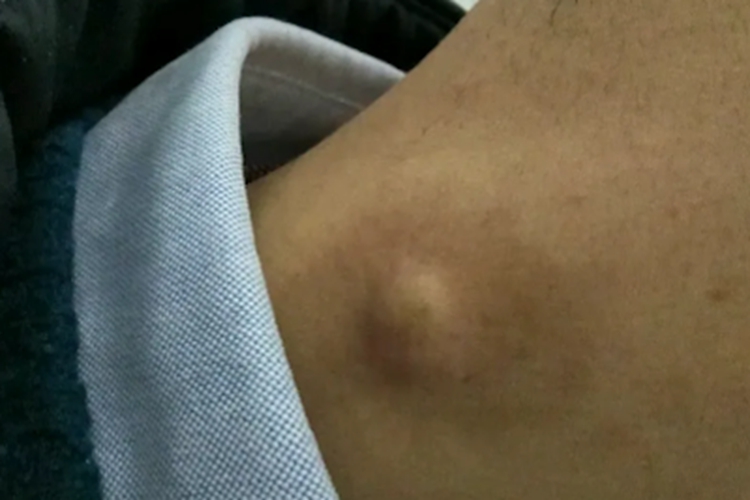 毛发囊肿侧颈疙瘩图