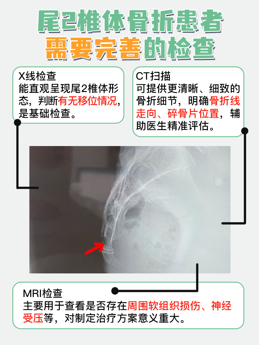 别轻视！尾2椎体骨折，多数人不知严重性