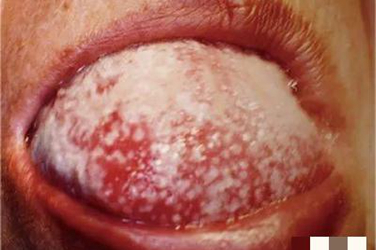 普通型猩红热舌头白点图