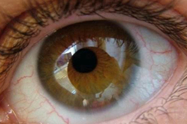 虹膜睫状体炎虹膜水肿图