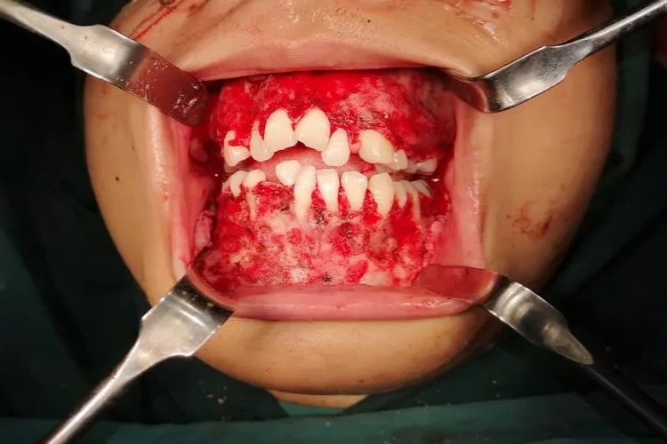 巨颌症牙齿畸形图