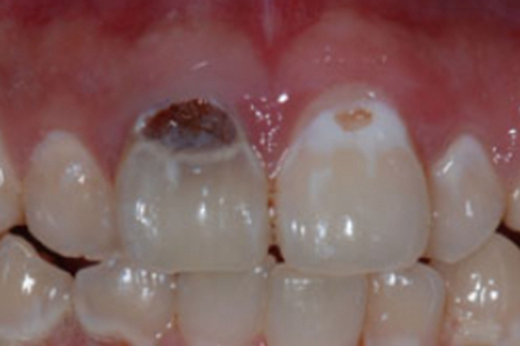 酸蚀症牙齿白斑图