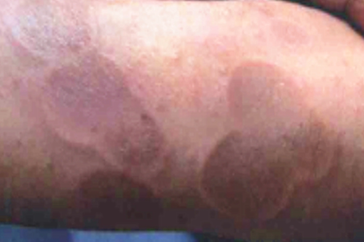 持久性色素异常性红斑胳膊红斑图 持久性色素异常性红斑胳膊红斑图