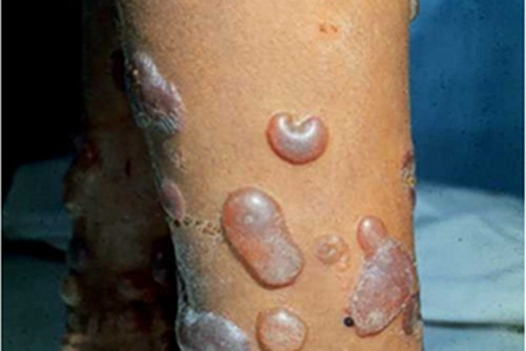 大疱性表皮松解症小腿水疱图 大疱性表皮松解症小腿水疱图