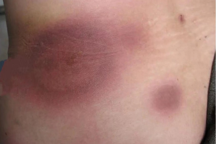 固定型药疹背部红斑图