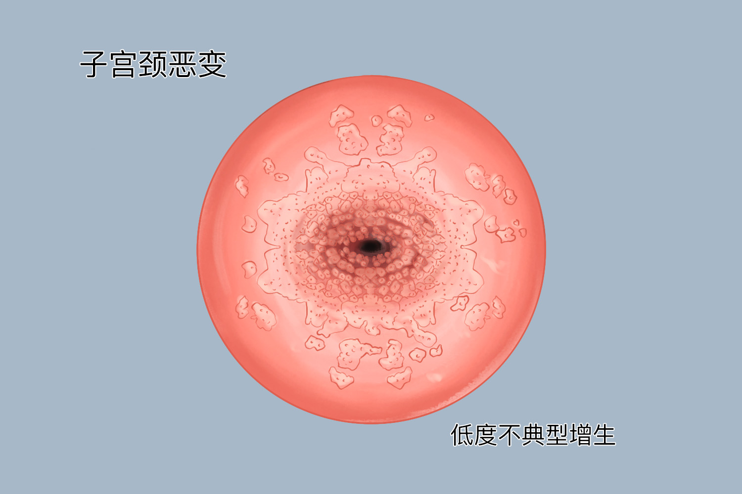 一级宫颈癌前病变图