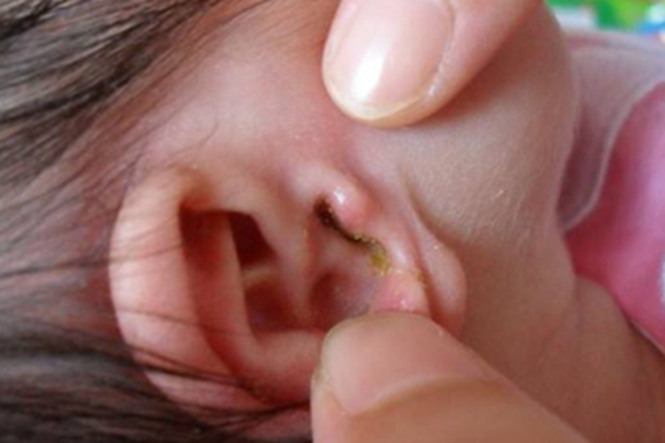 慢性化脓性中耳炎外耳道渗液图