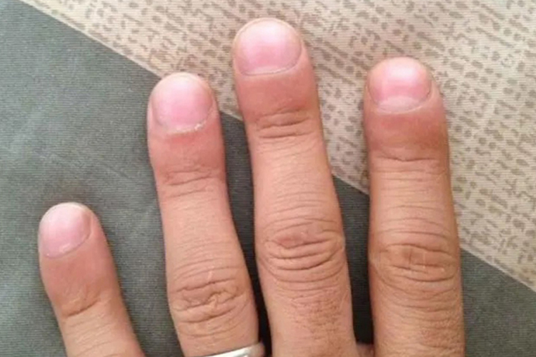 杵状指图 杵状指图