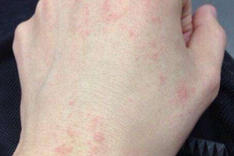 皮肤白血病手部症状图 皮肤白血病手部症状图