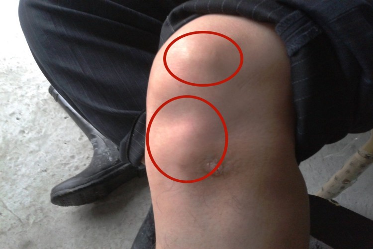 滑膜肉瘤膝盖症状图 滑膜肉瘤膝盖症状图