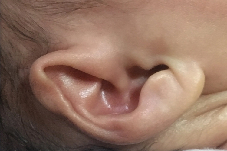 新生儿耳朵软骨压扁图