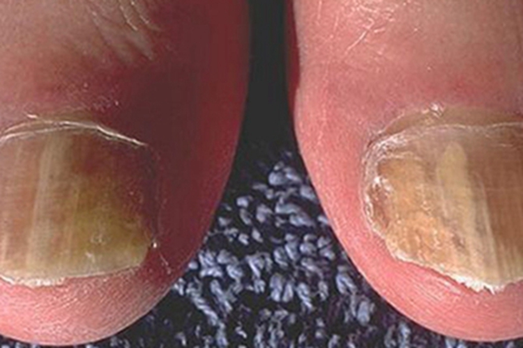 脆甲症脚趾甲竖纹图
