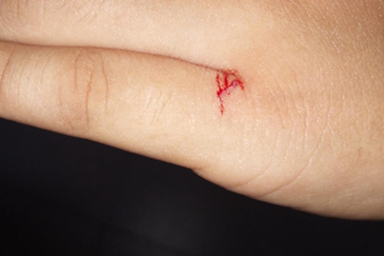 割伤手指出血图