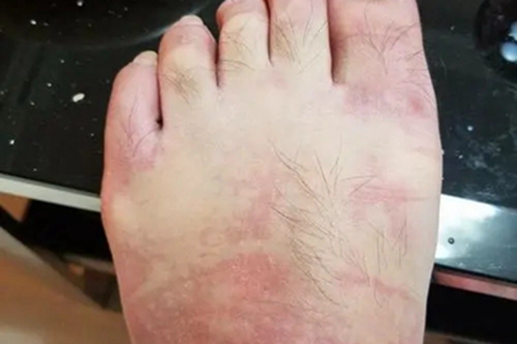 高IgD综合征脚背症状图 高IgD综合征脚背症状图