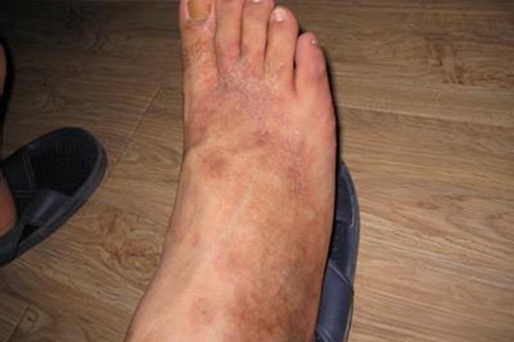 高球蛋白血症性紫癜脚部症状图