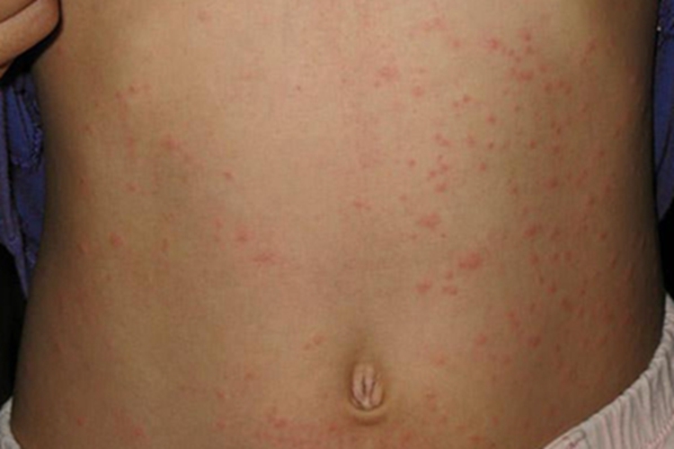 昆虫性皮炎腹部丘疹图