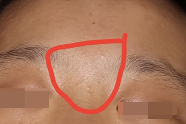 早熟性皮脂腺增生眉毛疙瘩图