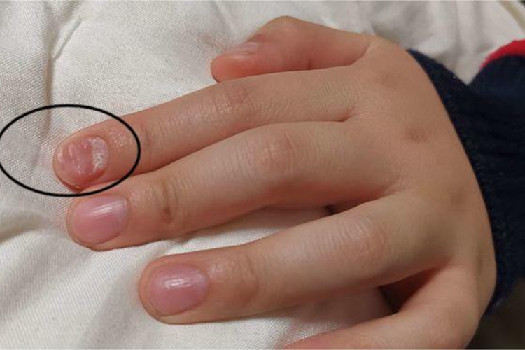 寄生虫感染手指甲波浪纹图