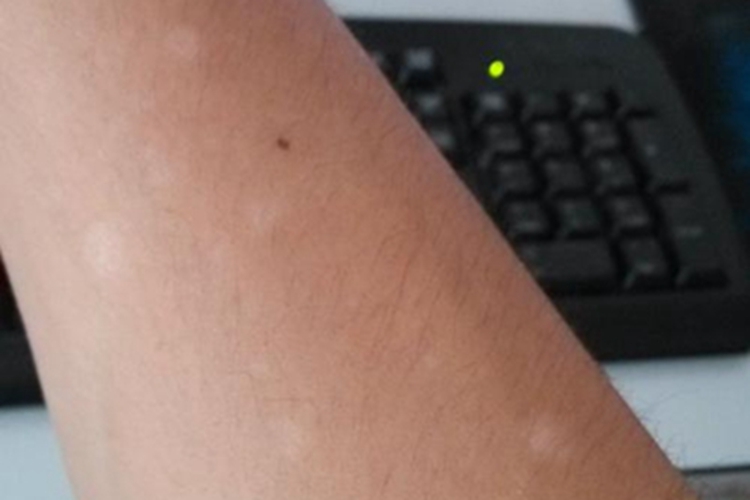 花斑癣早期白斑图