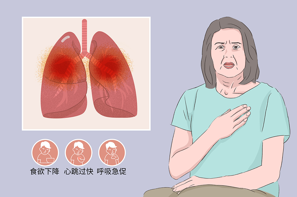 吸入性肺炎