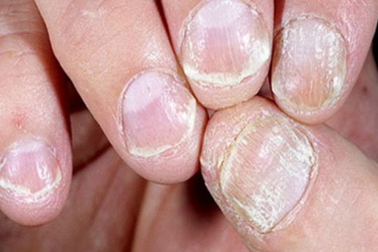 银屑病甲手指甲粗糙图