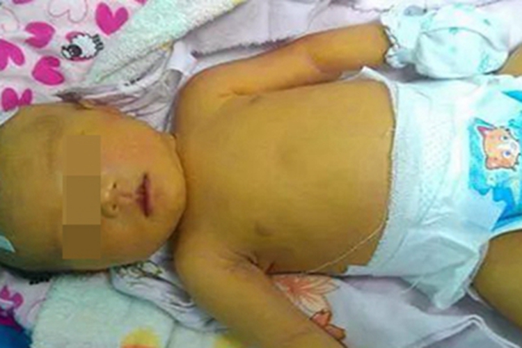 新生儿黄疸全身皮肤发黄图