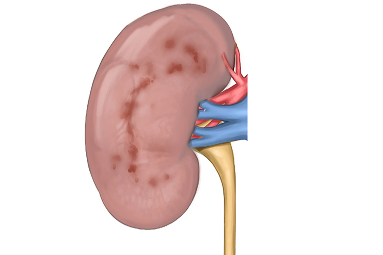 急进性肾小球肾炎图