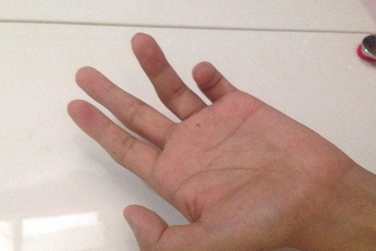 尺神经损伤爪形手图