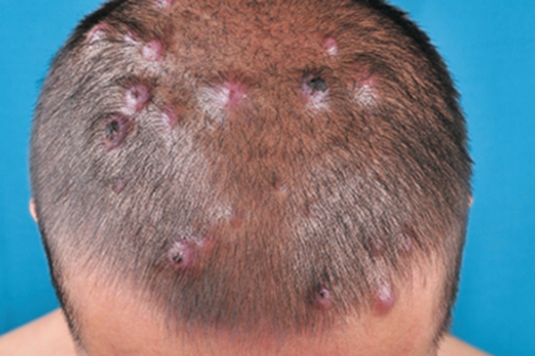 毛鞘棘皮瘤头皮黑痂图