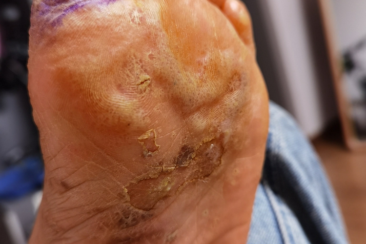 糖尿病患者脚部脓疱病图 糖尿病患者脚部脓疱病图