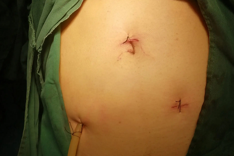 阑尾手术打孔位置图