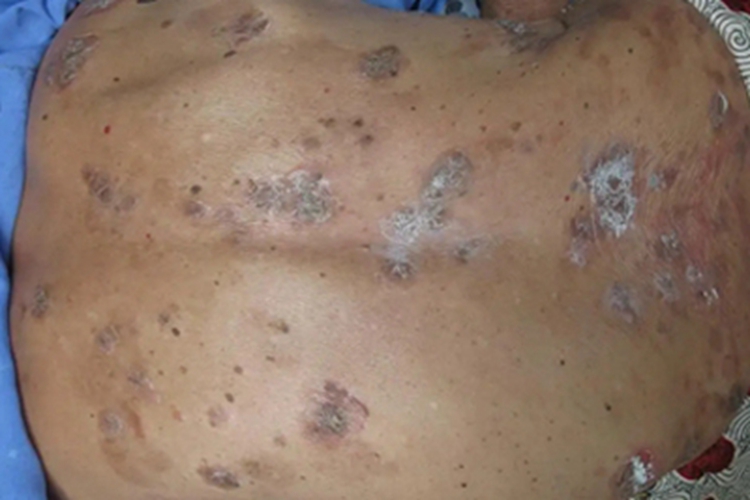 疱疹样天疱疮背部黑斑图
