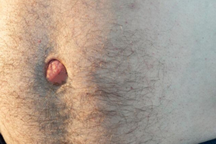 成人脐疝肚脐部鼓包块图