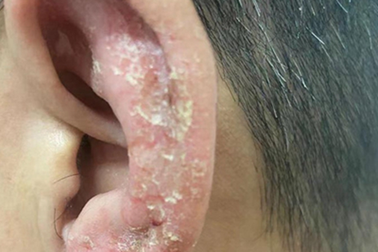 慢性湿疹耳廓起白皮图