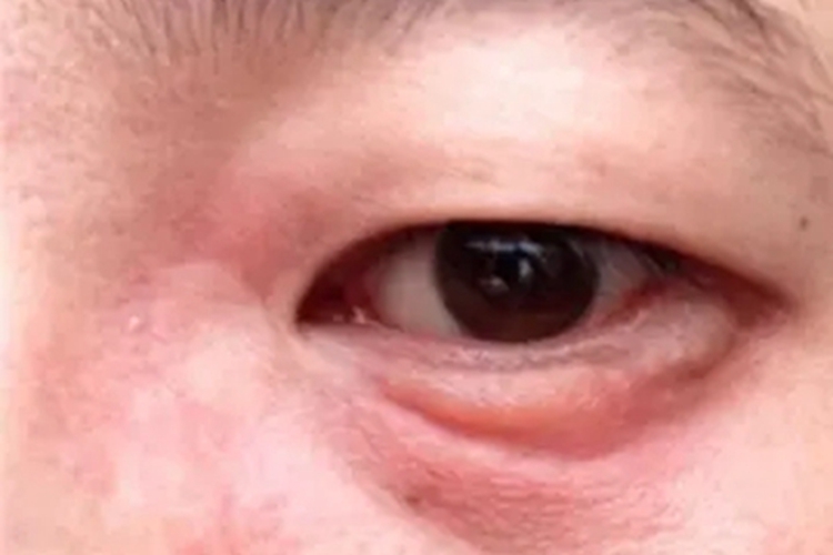 混合性结缔组织病眼睑症状图 混合性结缔组织病眼睑症状图