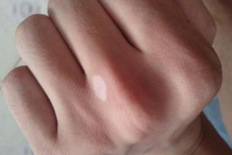 特发性点状色素减退斑白点图