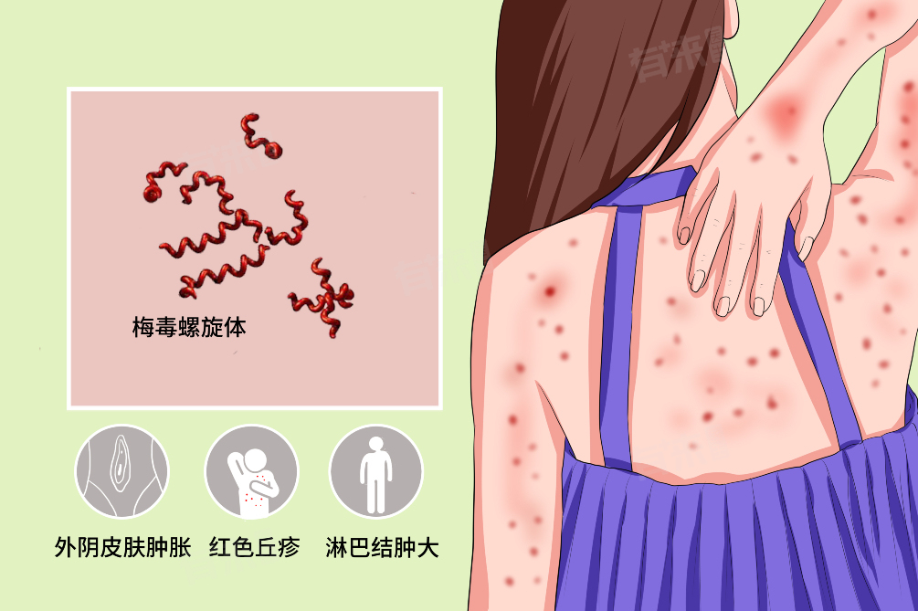 隐性梅毒能治愈吗